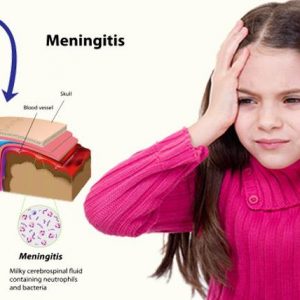 تحقیق مننژیت حاد باکتریایی در نوزادان و کودکان