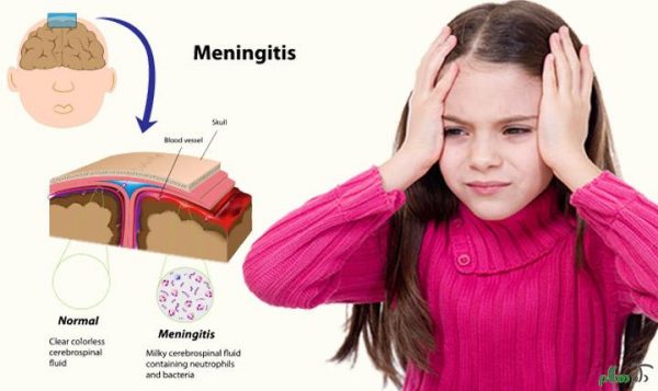 تحقیق مننژیت حاد باکتریایی در نوزادان و کودکان